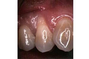 Gingival graft for root coverage before